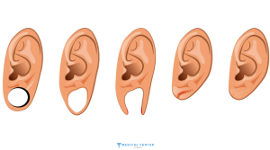 Earring Hole Repair Surgery in Turkey 2025