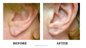 Earring Hole Repair Surgery in Turkey 2025