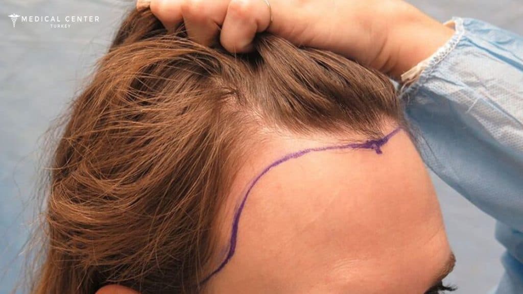 Emily’s Hair Transplant Journey