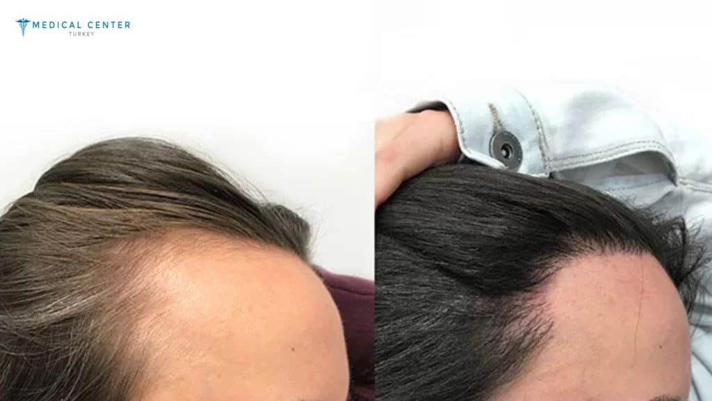 Emily’s Hair Transplant Journey