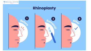 Rhinoplasty Prices in Turkey