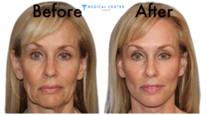 FacelIft at Home How to do FacelIft without Surgery (4)
