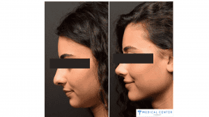 Female Rhinoplasty In Turkey