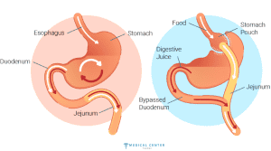 Frequently Asked Questions About Gastric Bypass Surgery 4