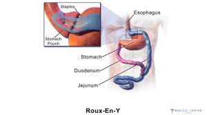 Frequently Asked Questions About Gastric Bypass Surgery 5