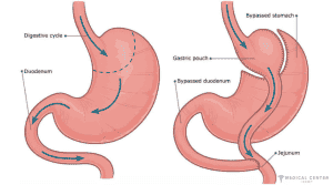Frequently Asked Questions About Gastric Bypass Surgery 7