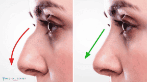 Rhinoplasty Surgery 1