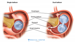 Gastric Balloon Coat in Turkey