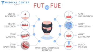 Hair Transplant Cost U.S. vs Turkey