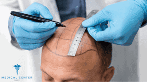 Hair Transplant Cost U.S. vs Turkey