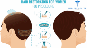 Hair_Transplation_for_Women_in_Turkey