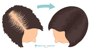 Hair Transplant in Turkey: Best Doctors 