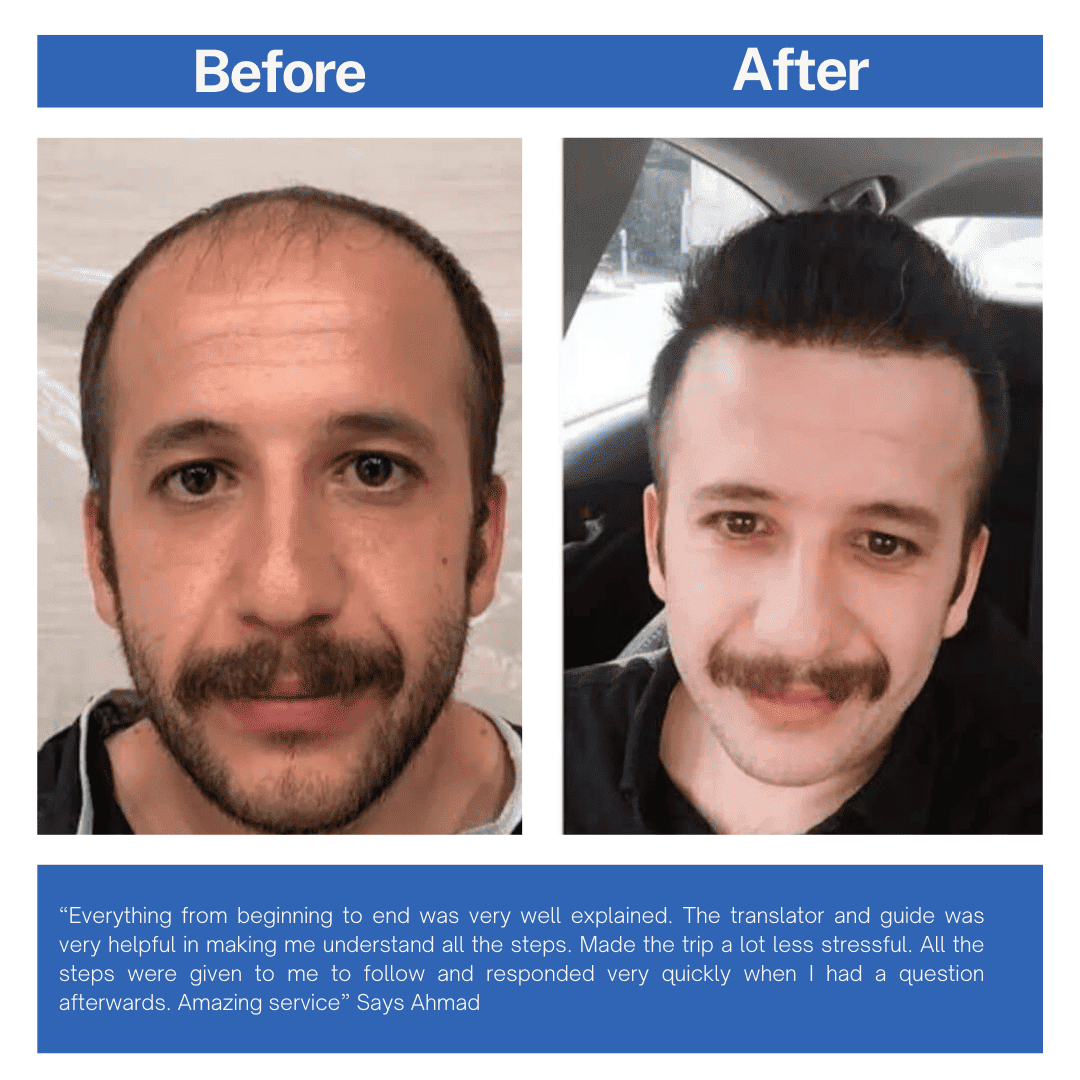 Hair Transplant Before and After Turkey