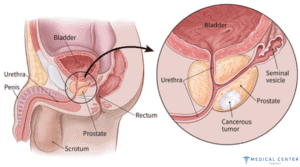 HIFU for Prostate Cancer