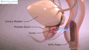 HIFU for Prostate Cancer