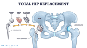 Hip Replacement in Turkey