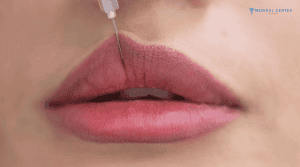 How Long Do Lip Filler Last?