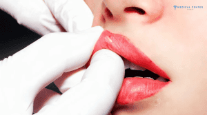 How Long Do Lip Filler Last?