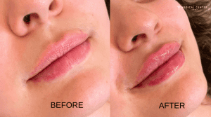 How Long Do Lip Filler Last?