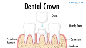 How Long Does a Dental Crown Last
