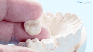 How Long Does a Dental Crown Last