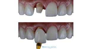 How Long Does a Dental Crown Last