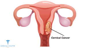 How Much Does Cervical Cancer Treatment Cost
