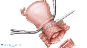How Much Does Cervical Cancer Treatment Cost