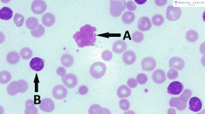 How Much Does It Cost to Treat Lymphoma?