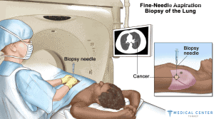 How Much is Lung Cancer Treatment?