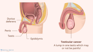 How Testicular Cancer is Treated