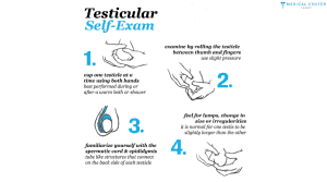 How Testicular Cancer is Treated