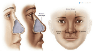 How to Prepare for Your Nose Surgery Procedure