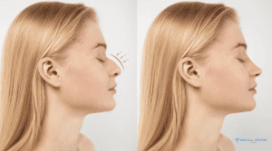 How to Prepare for Your Nose Surgery Procedure