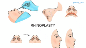How to Prepare for Your Nose Surgery Procedure