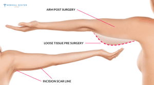 How to Recover After Arm Lift?