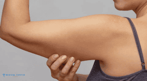 How to Recover After Arm Lift?