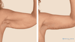 How to Recover After Arm Lift ?