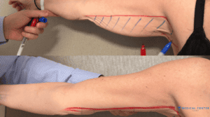 How to Recover After Arm Lift ?