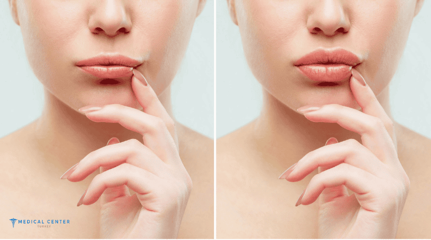 How Will Your Lip Fillers Look More Natural in 2026?