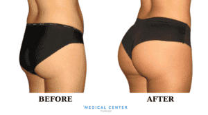 Is Butt Lift Painful 
