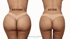 Is Butt Lift Painful 