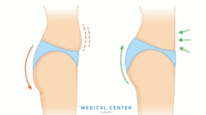 Is Butt Lift Painful 