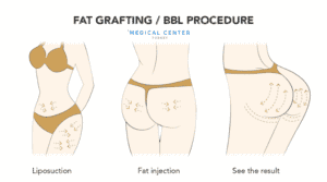 Is Butt Lift Painful 