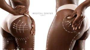 Is Butt Lift Painful 