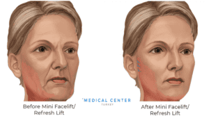 Is Facelift Painful
