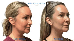 Is Facelift Painful 