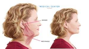 Is Facelift Painful 