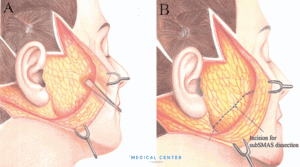 Is Facelift Painful 