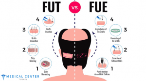 Is Hair Transplant Painful?
